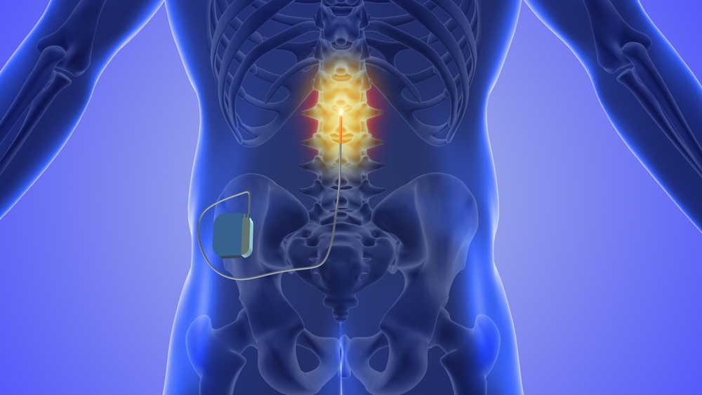 diagram of spinal stimulator in the human body - Lawsuit Legal News